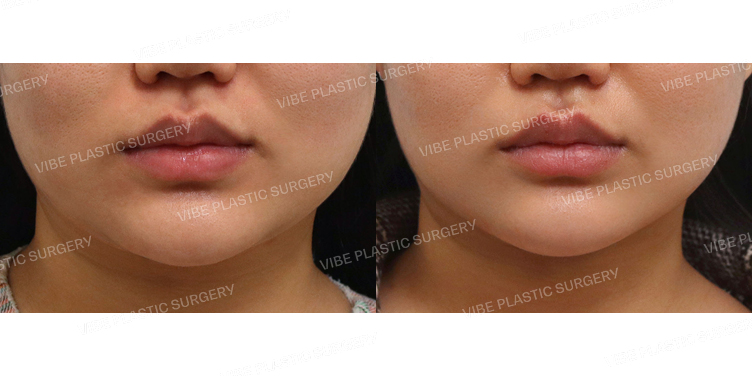 #초음파지방흡입(이중턱,턱라인) #슈링크