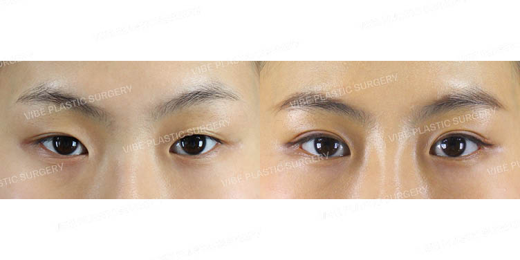 #비절개눈매교정 #뒤트임