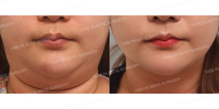 #초음파지방흡입 실리프팅(이중턱,턱라인)