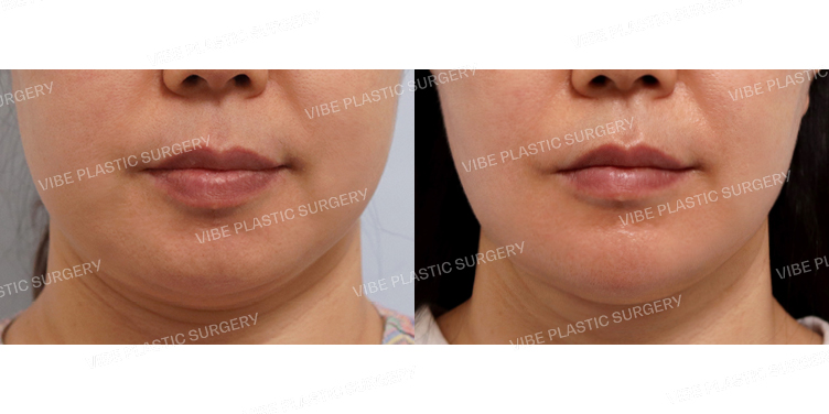 #실루엣리프팅 #리포사운드지방흡입