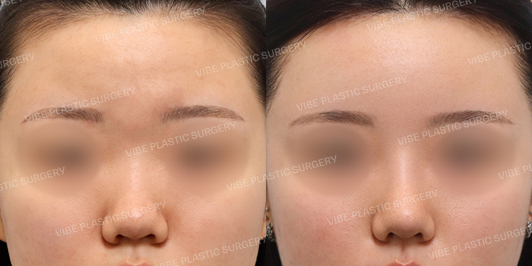 #콧대 #코끝 #지방이식