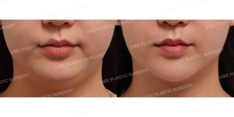 #초음파지방흡입(이중턱)