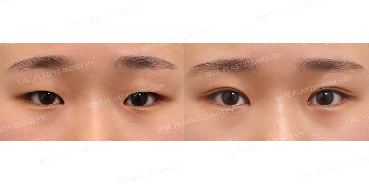 #절개쌍꺼풀 #앞트임