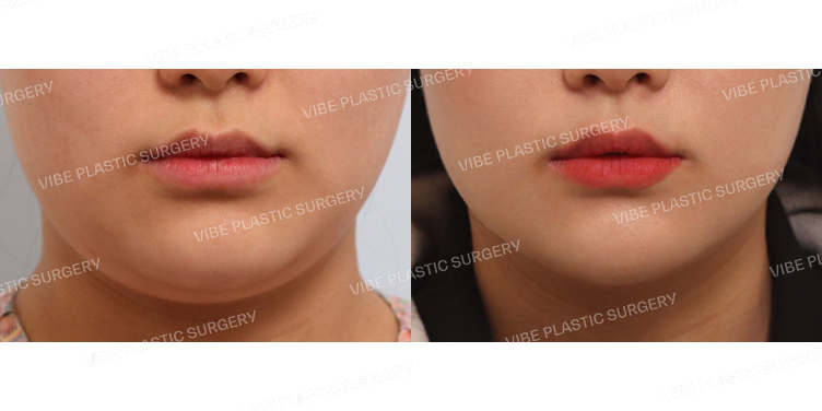 #초음파지방흡입(이중턱,턱라인)