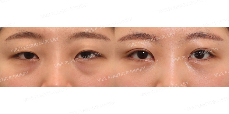 #부분절개눈매교정 #앞트임 #눈밑지방재배치