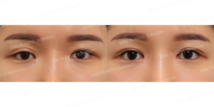 #절개눈매교정(3번째재수술) #앞트임(재수술)