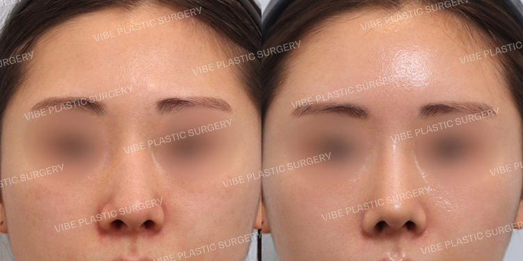 #무보형물 #매부리코 #휜코 #이마지방이식