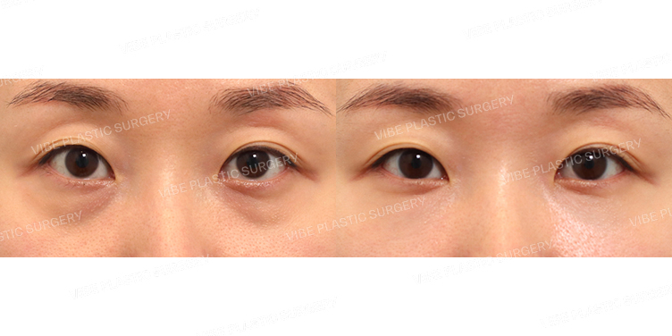 #눈밑지방재배치 #미세지방이식