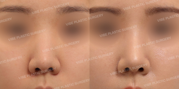 #무보형물 #복코 #매부리코