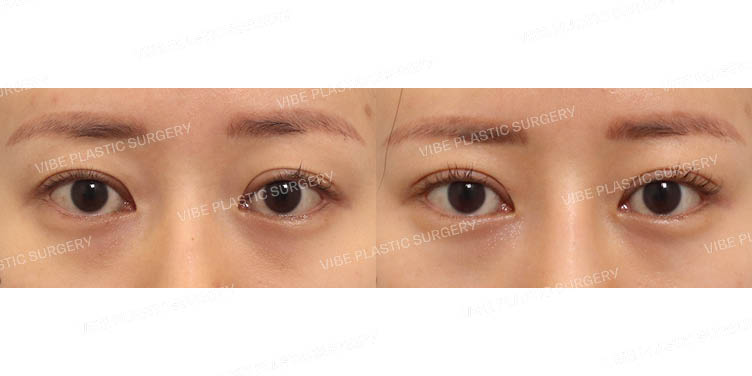 #자연유착(재수술)