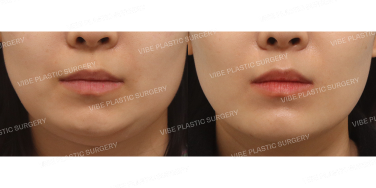 #초음파지방흡입(이중턱&턱라인) #턱보톡스