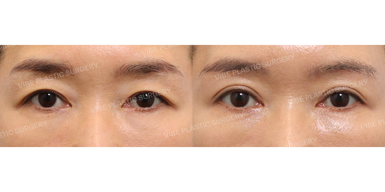 #눈썹밑거상 #자연유착