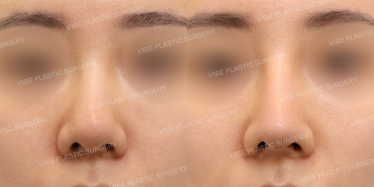 #코재수술 #복코 #매부리코