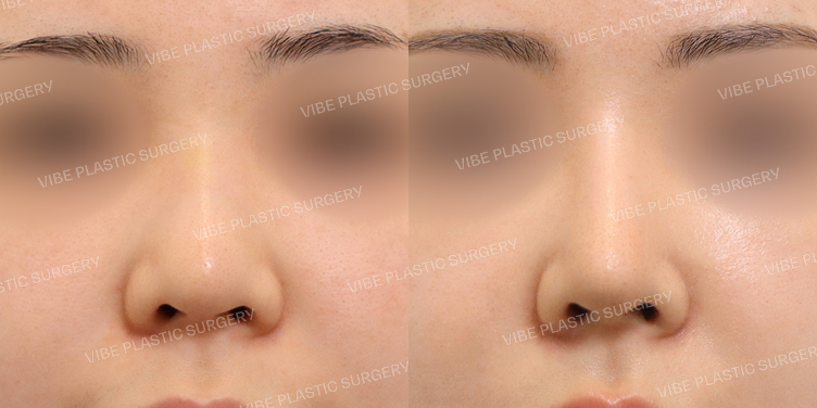 #필러제거 #이물질제거 #복코 #비주빼기 #실리콘보형물