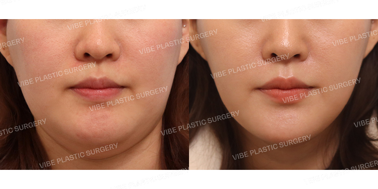 #리포사운드지방흡입(이중턱,턱라인,옆광대)