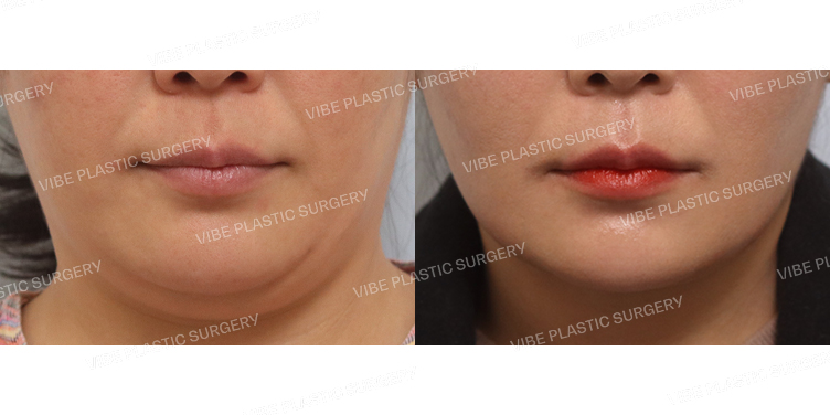 #실리프팅 #초음파지방흡입(이중턱,턱라인)