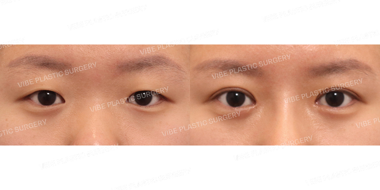 #절개눈매교정 #앞트임