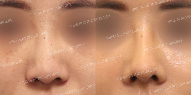 #낮은코 #복코 #긴코