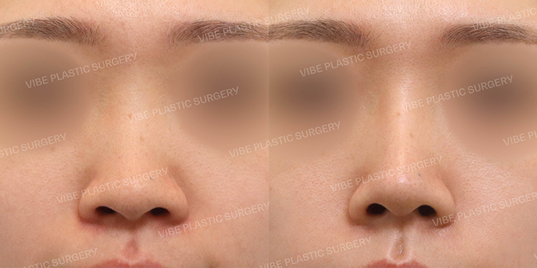 #매부리코 #화살코 #비중격연장이식