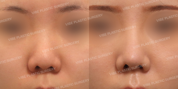 #복코 #비주교정