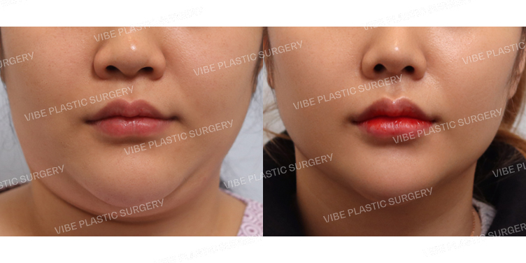 #초음파지방흡입(이중턱,턱라인,앞볼)