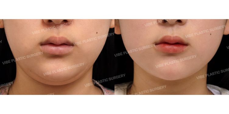 #초음파지방흡입(이중턱,턱라인)