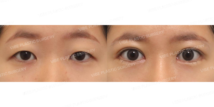 #절개눈매교정 #앞트임 #뒤트임 #밑트임