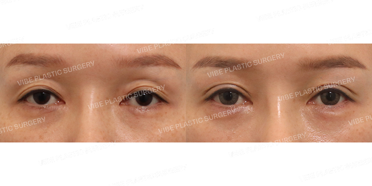 #절개눈매교정(지방재배치) #애교필러