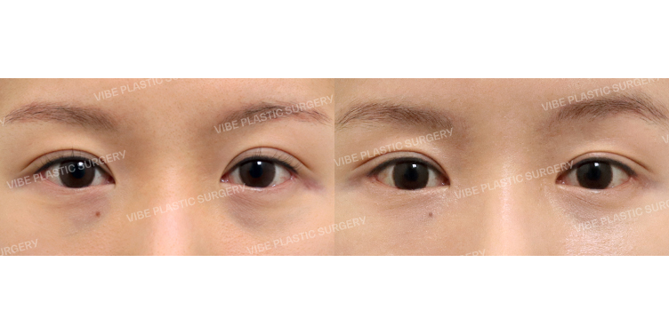 #눈재수술 #절개쌍꺼풀