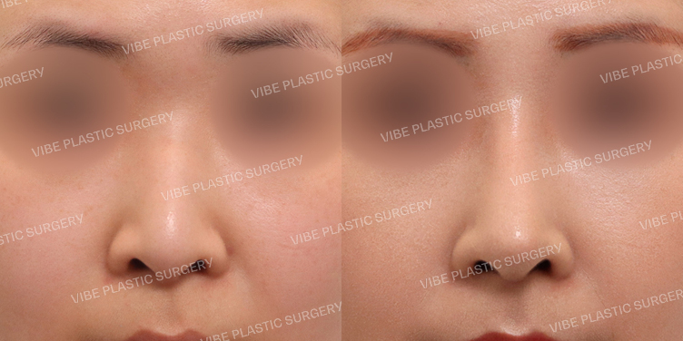 #매부리코 #낮은코