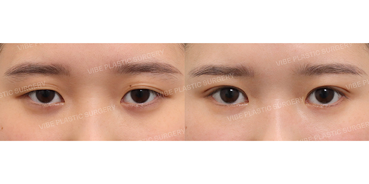 #부분절개눈매교정