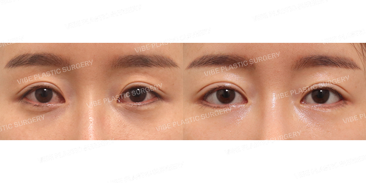 #절개쌍꺼풀(재수술) #뒤트임 #밑트임