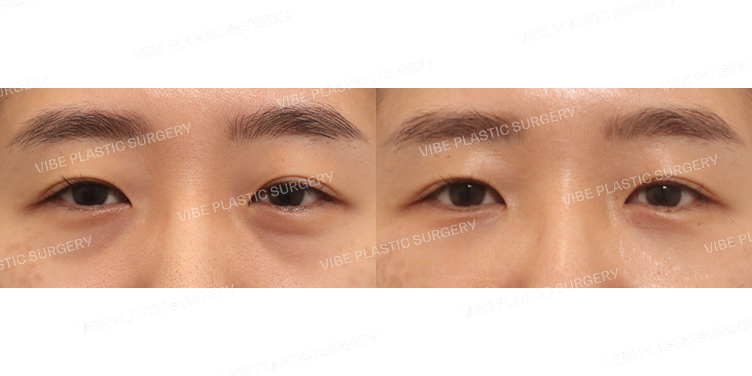 #눈밑지방재배치