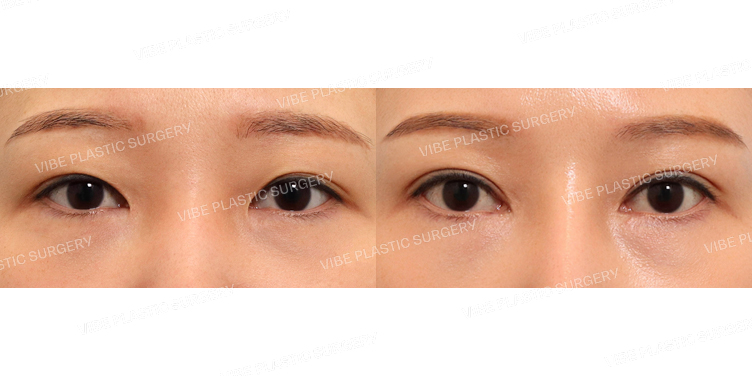 #절개쌍꺼풀 #앞트임(재수술)