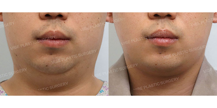 #초음파지방흡입(이중턱,턱라인)