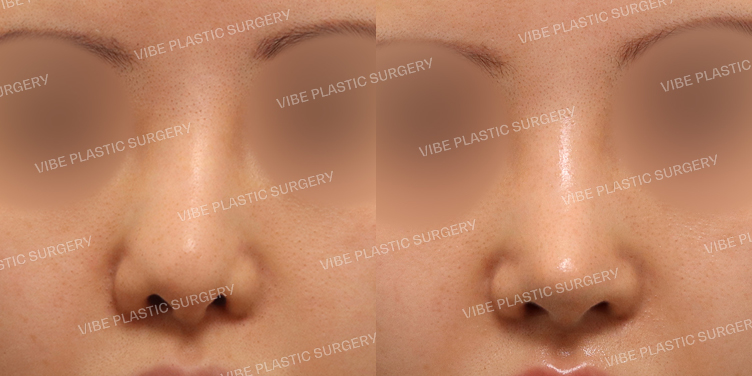 #기능코(재수술)