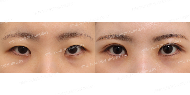 #자연유착 #앞트임