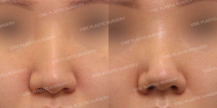 #무보형물 #매부리코 #긴코 #복코