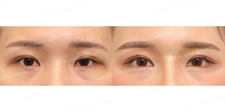 #앞트임 #뒤트임 #밑트임