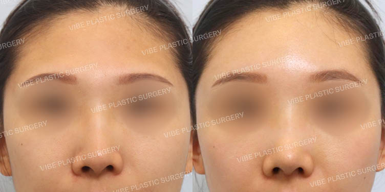 #무보형물 #매부리코 #긴코 #넓은코 #이마지방이식 #내시경이마거상