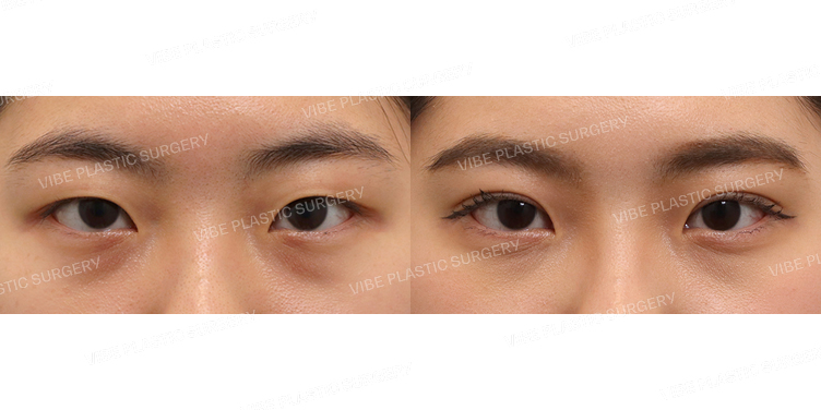 #부분절개눈매교정