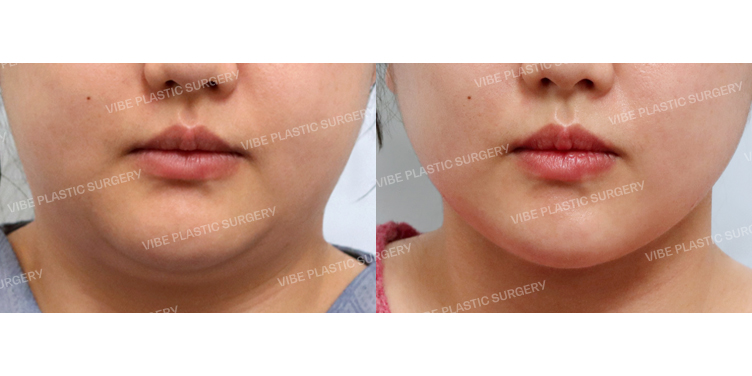 #초음파지방흡입(이중턱,턱라인) #목거상(이중턱근육묶기) #심부볼지방제거