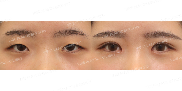 #비절개눈매교정 #앞트임