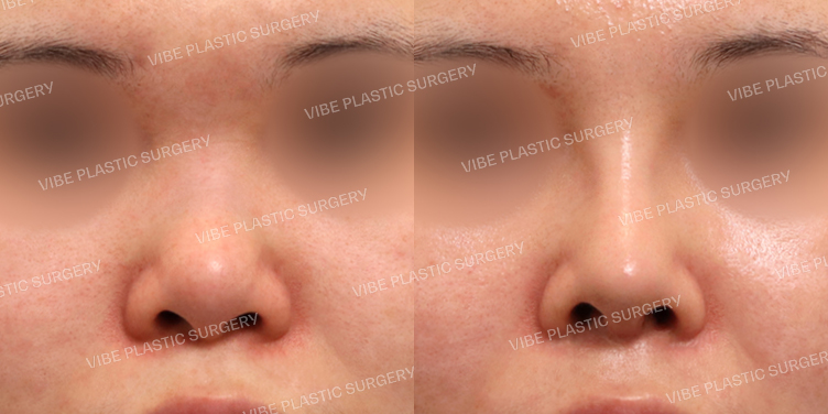 #짧은코 #낮은코 #복코