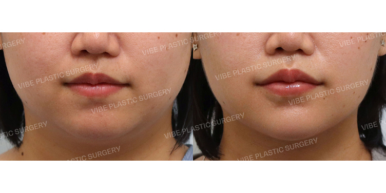 #이중턱근육묶기(목리프팅) #초음파지방흡입(리포사운드)