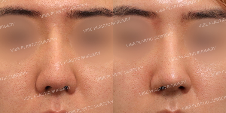 #휜코 #코끝 #보형물교체