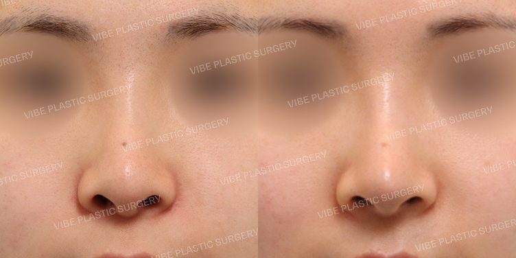 #코재수술 #보형물교체 #코끝 #복코 #비공교정