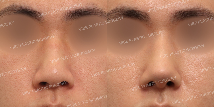 #무보형물 #매부리코