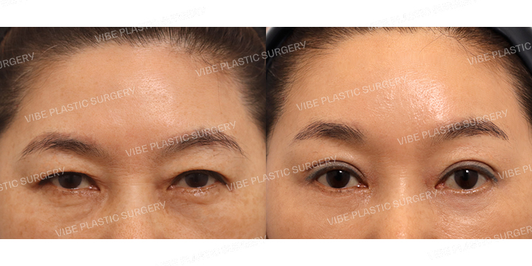 #내시경이마거상 #비절개눈매교정 #하안검