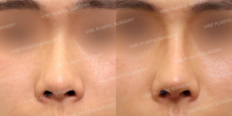 #남자코 #짧은코